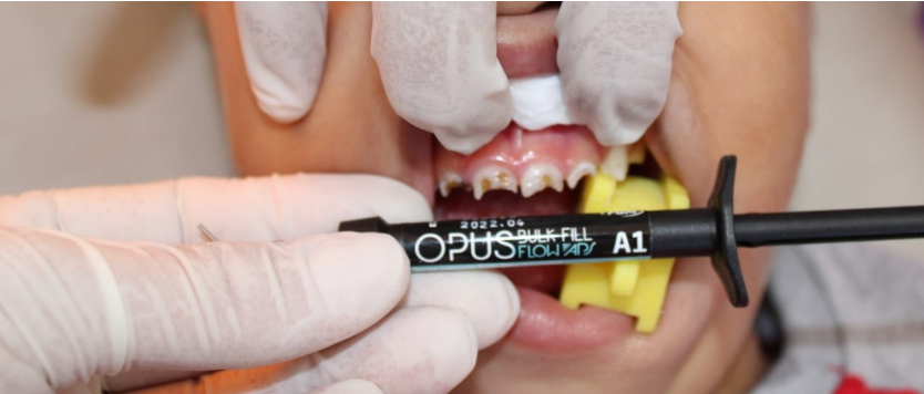 Caso estética dental en odontopediatria