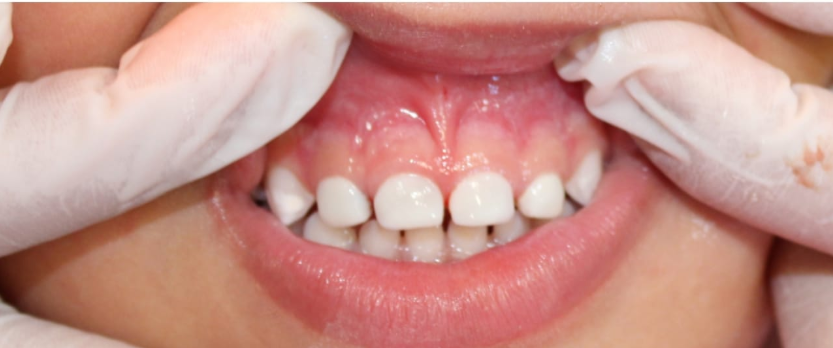 Caso estética dental en odontopediatria