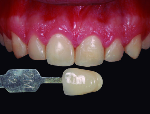 Cierre de Diastema en Sector Anterior con Blanqueamiento Dental