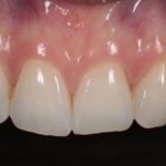 Tratamiento de manchas blancas en dientes con FGM