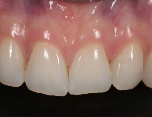 Tratamiento de manchas blancas en dientes con FGM