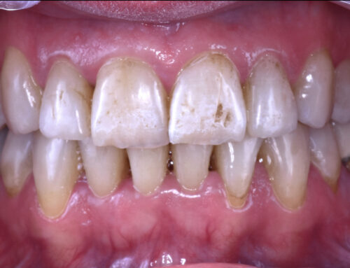 Cambio de color en sustrato desfavorable con FGM